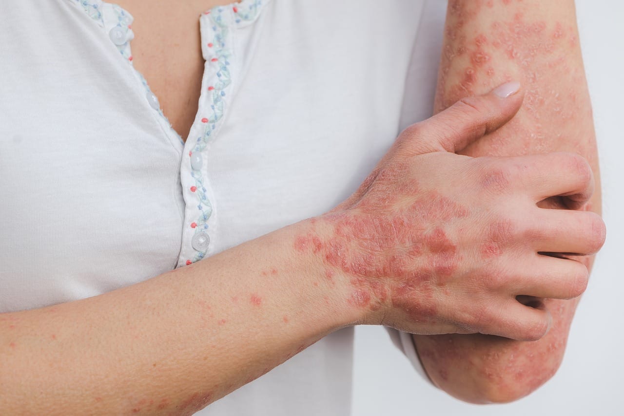 What makes my psoriasis worse? A comprehensive guide to triggers
